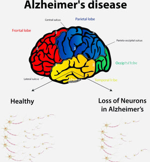 Alzheimer's Disease - 05.17.2022